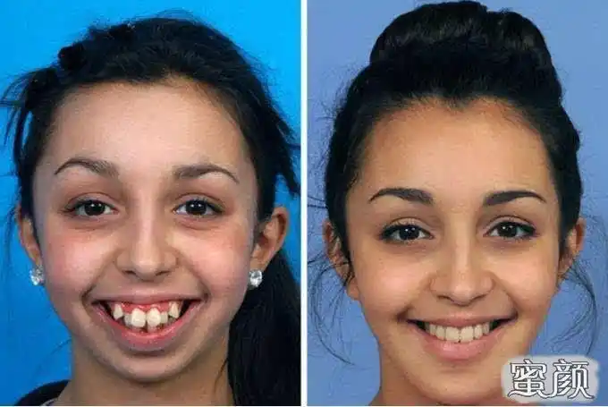 龅牙矫正需要多少钱?2分钟医生带你了解
