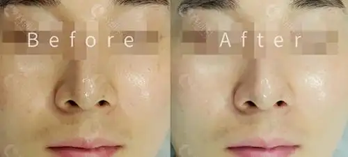 这种瘢痕样改变是无法简单依靠使用护肤品来真正修复的