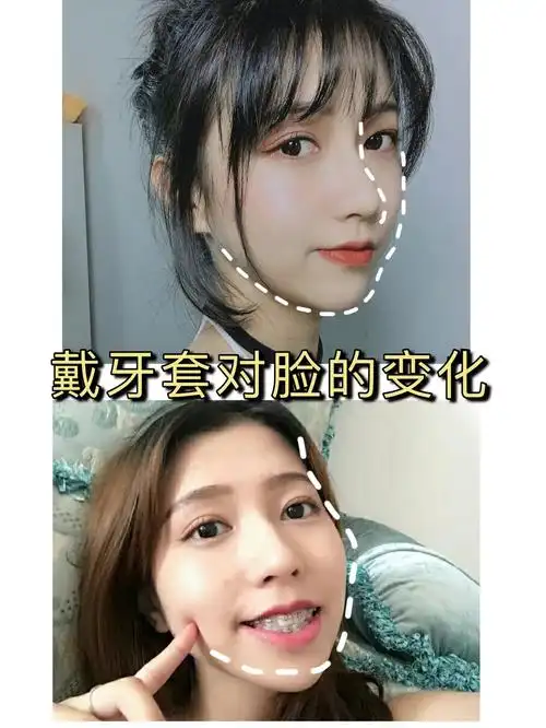 年龄是否影响牙套的效果?