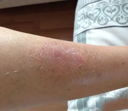 胳膊肘关节长癣图片