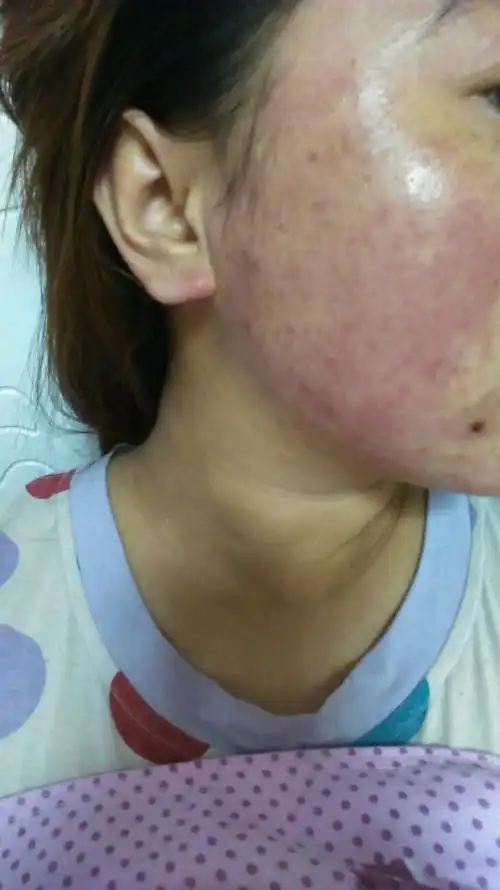 品过敏了,起了很多小疙瘩,小水泡,现在还脱皮,脸部红红的,皮肤还很干