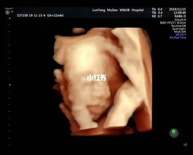 刚看到四维的时候我跟孩他爸都惊呆了,大鼻子,厚嘴唇,感觉还有点腭裂