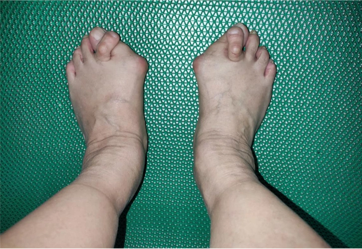 拇外翻_发病原因_治疗方式 - 好大夫在线