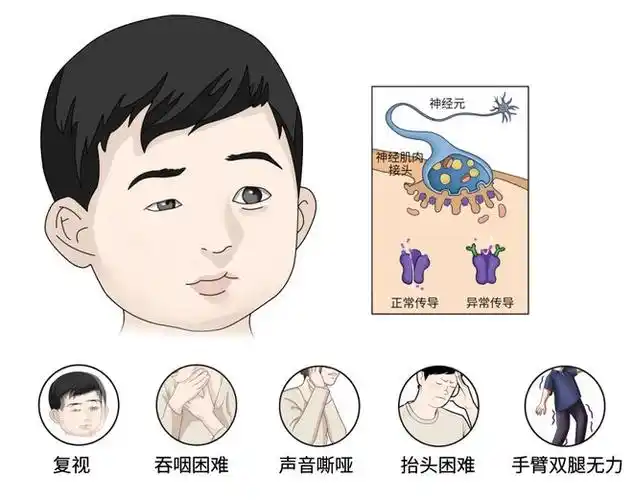 医患携手优化疾病管理,"托起"重症肌无力患者人生|危象|治疗|症状