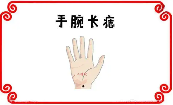 手腕长痣