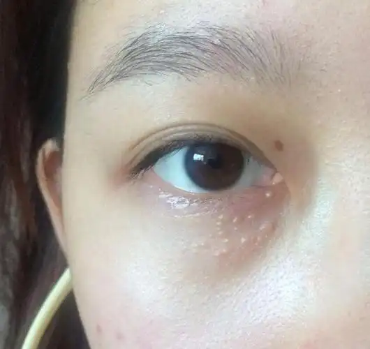 【护肤师小凡分享】眼睛下面长了脂肪粒怎么办?