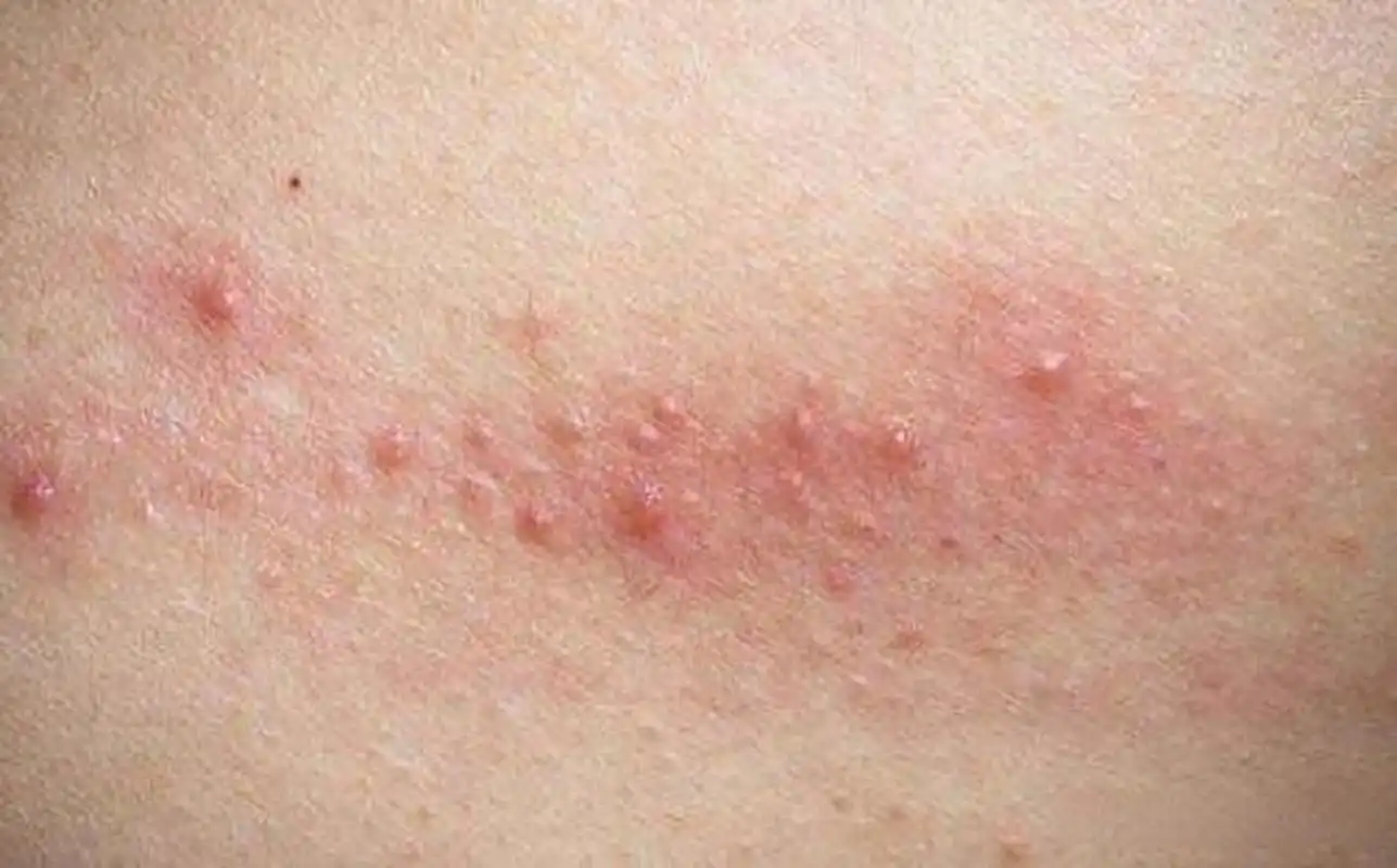 1,乳房皮肤过敏表现为皮肤发红,偶有皮疹出现,瘙痒难耐.