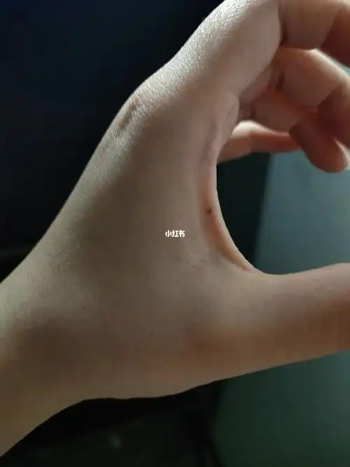 俺左手虎口那突然长了颗痣