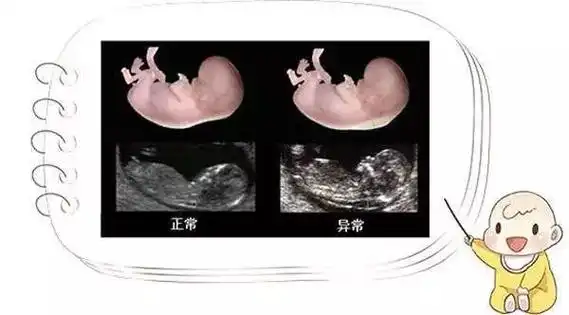 nt检查——准妈妈不可错过的第一次排畸!_胎儿