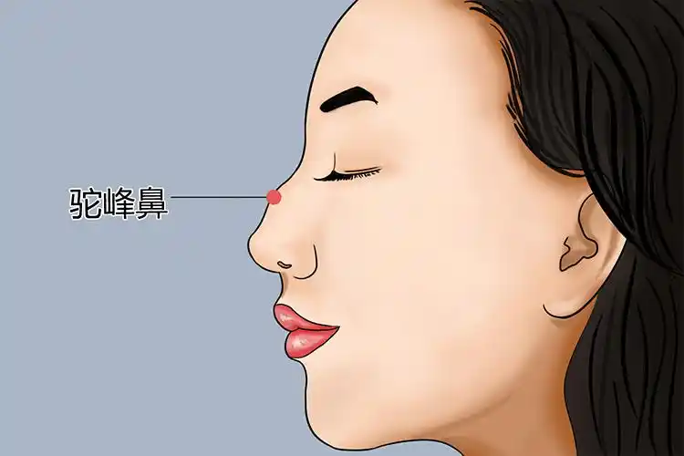 驼峰鼻