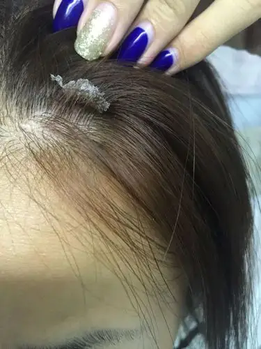 为什么头发上会有这么大块皮 还有我是才洗了头 额头前面全是这样的