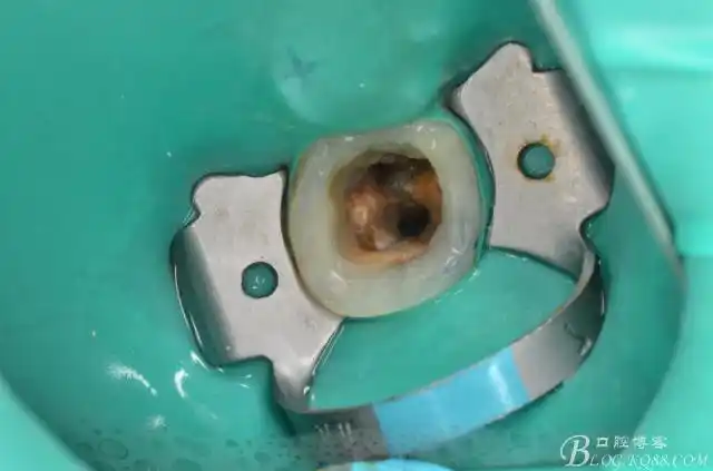 第二磨牙残根橡皮障下rct现代根管治疗培训后的改进