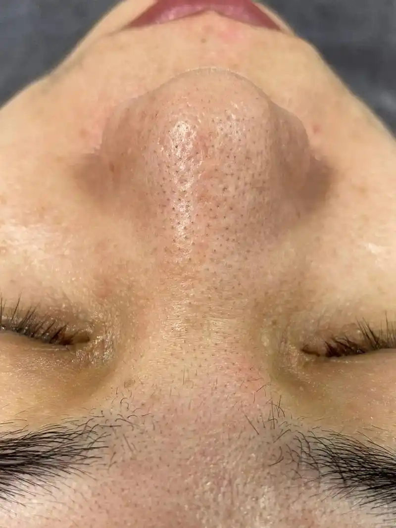 痘痘黑头粉刺拜拜 #深层毛孔清洁 - 皮肤护理进行时  : - 抖音