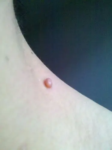 肉球半透明状,平时不痛不痒但有时会好痒,痘痘也奇怪有的会自己长大有