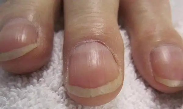 指甲这个形状可能是心脏病前兆