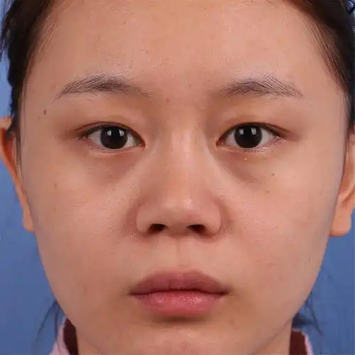 3.鼻翼有点肥大.