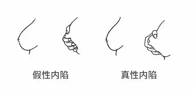 乳头是凹进去的,这正常吗?还能哺乳吗?