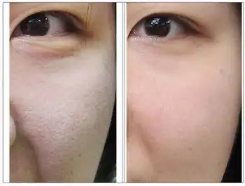 毛孔粗大,对比图,长春好的整形医院