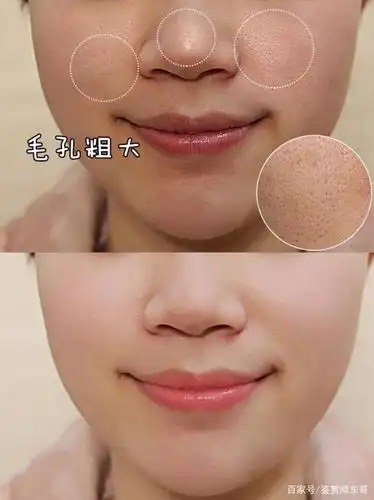 收缩毛孔选择什么医美项目毛孔粗大必看