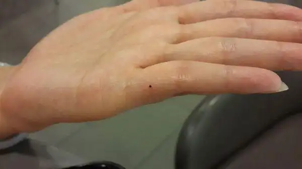 手指上这个黑点是怎么回事?