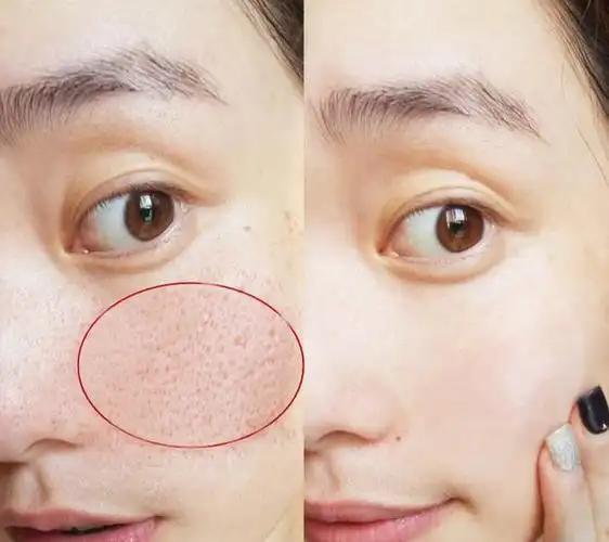 脸颊毛孔大是什么原因?脸颊毛孔大怎么改善?