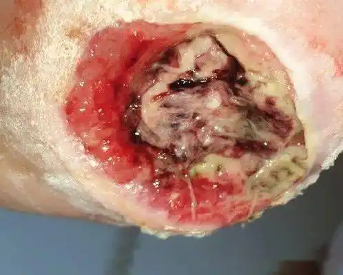 不同类型的伤口图片认识一下中