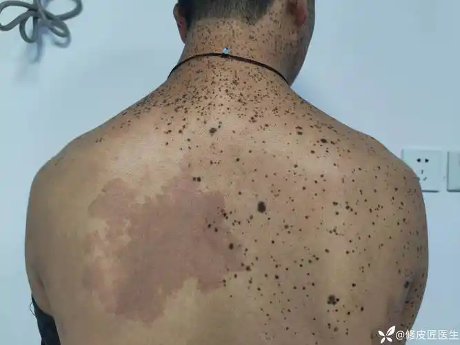 一个人身上出现了多种皮肤问题