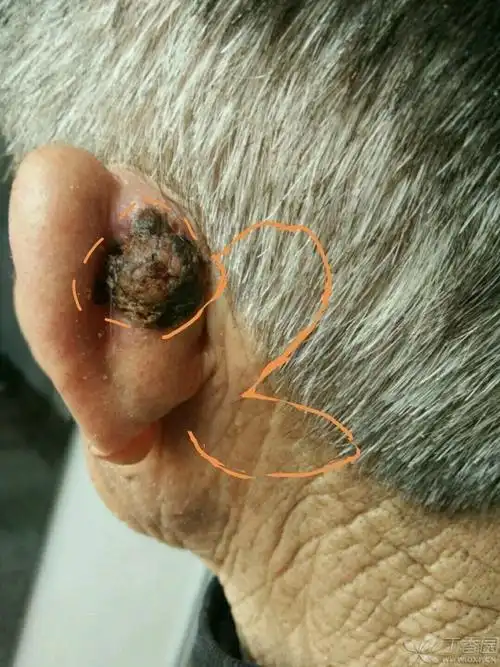 【讨论】耳廓皮肤癌
