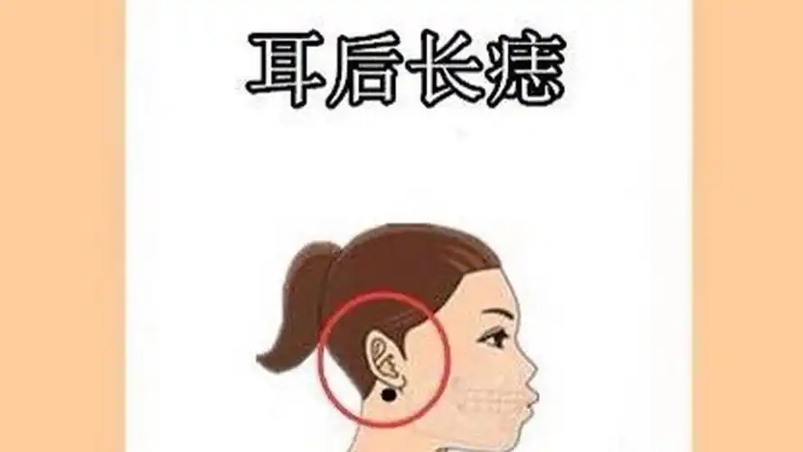 耳后长痣  在相学当中,若是一个人的耳朵后边的位置处长有吉痣,一般为