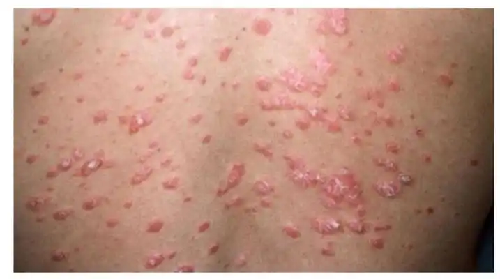 红色斑丘疹 (27)