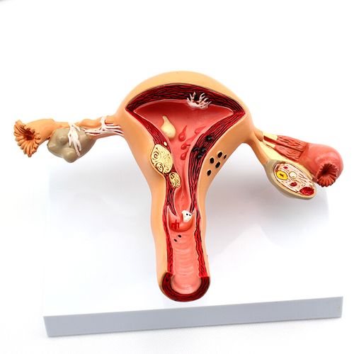 人体女性子宫疾病模型生殖科妇产科医患沟通讲解演示模型子宫妇科
