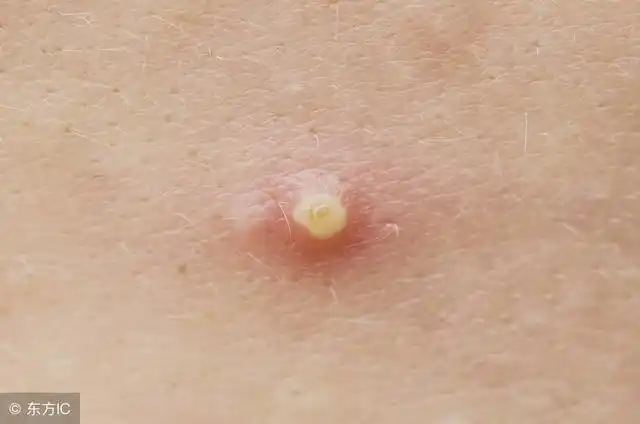 后背出现这些现象,证明螨虫已在你的后背里定居,掌握方法很重要