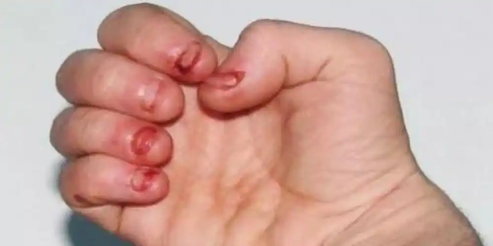 爱啃指甲的孩子长大手指都怎么样了呢医生难逃这2种结果