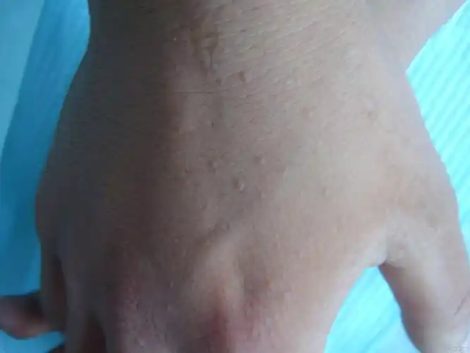 点状掌跖角化症 - 皮肤及性传播疾病讨论版 - 爱爱医医学论坛