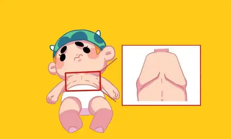 儿童缺钙导致的鸡胸外观图是什么样的