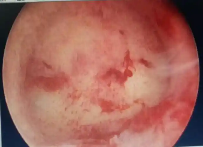 宫腔镜检查之宫颈癌