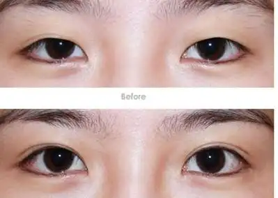 割双眼皮前后对比