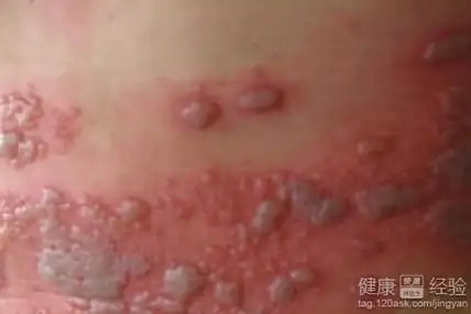 精准抗艾-互联网艾滋病性病预防诊疗平台