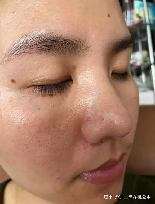 女生脸上毛孔粗大怎么办? - 知乎