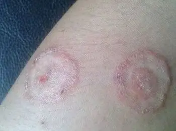 宝宝体癣症状是怎样的