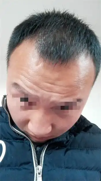 前额脱发严重,m字型脱发惠州的医院可以治好吗?