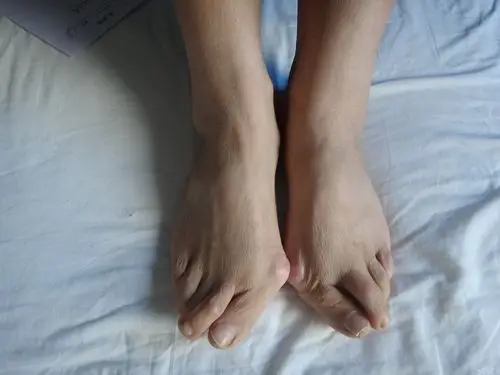 一例双足拇外翻 [病例帖]