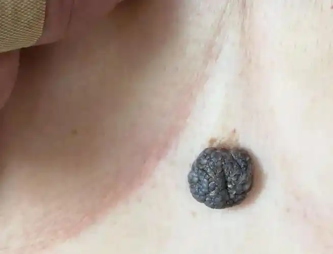 身上的小疙瘩——硬纤维瘤