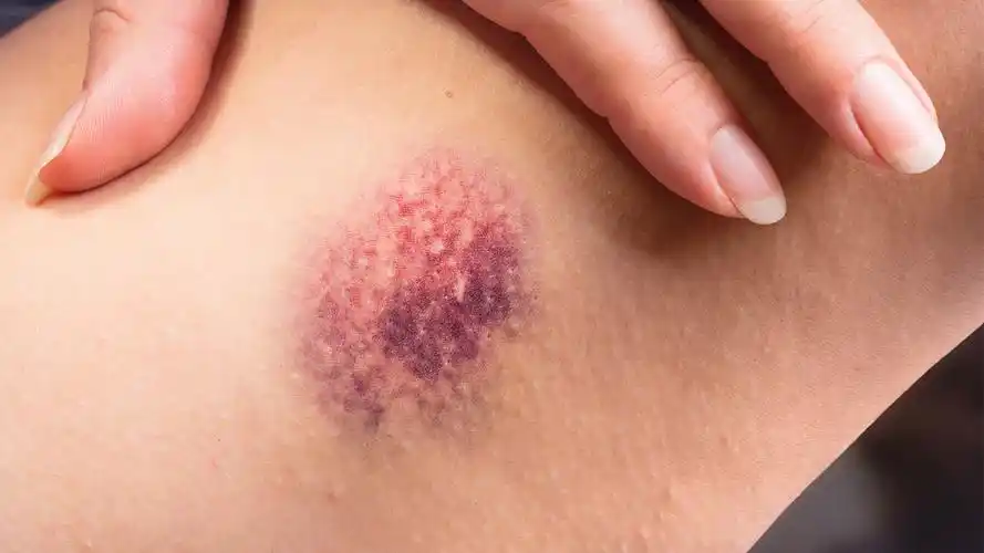 新生儿先天性鱼鳞病