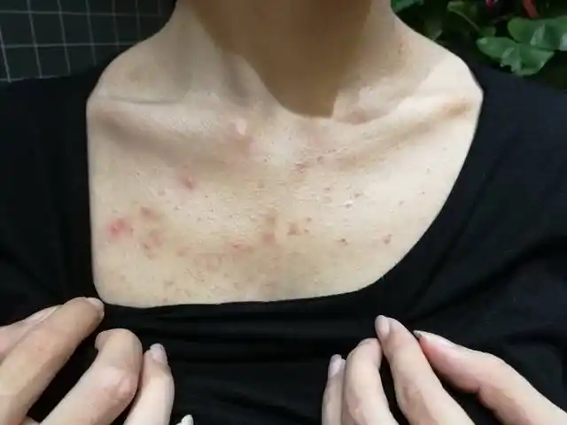 提醒:胸前长痘不一定是上火,也可能是这3原因,2种天然物,多用可祛痘