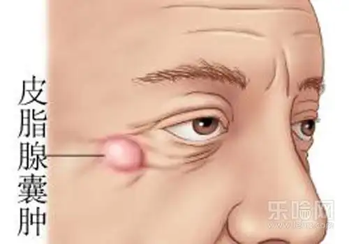 皮下囊肿是怎么形成的