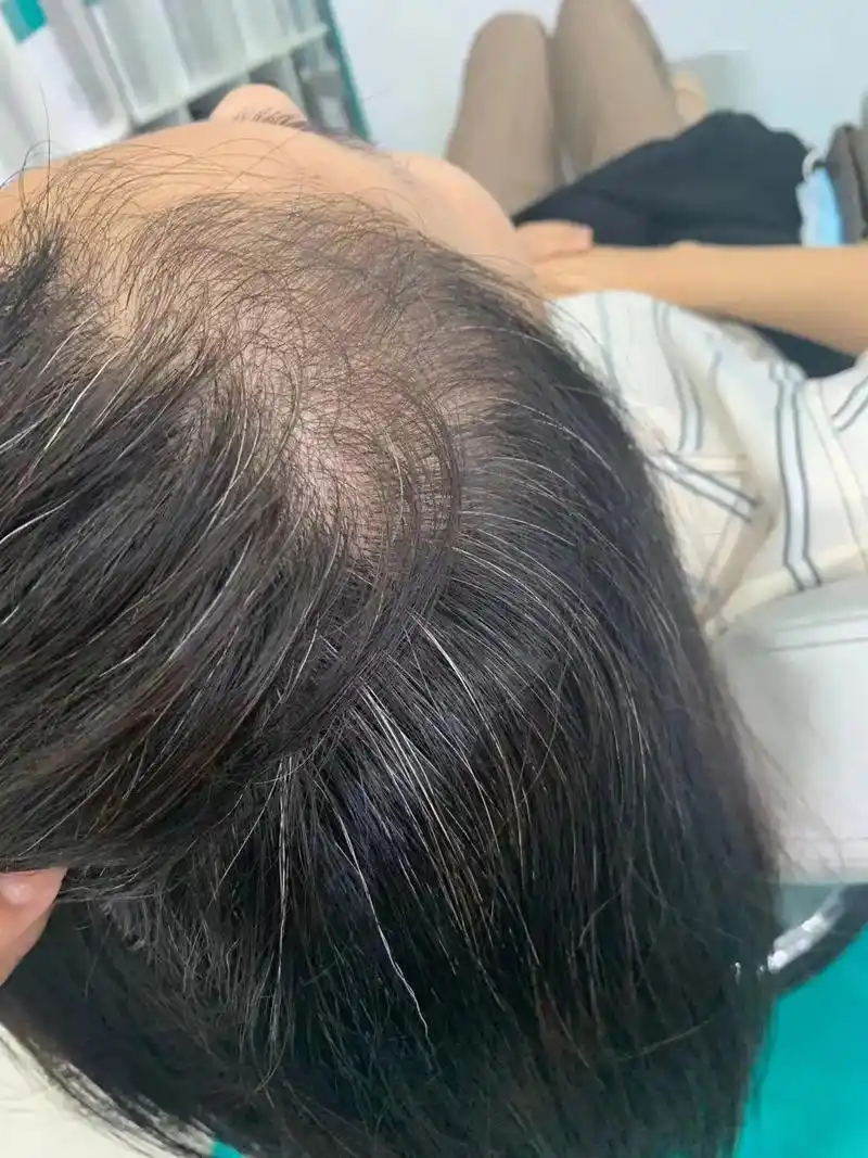 银行小姐姐不仅有白发头顶还稀疏后三张照片是治疗三个月以后的效果图