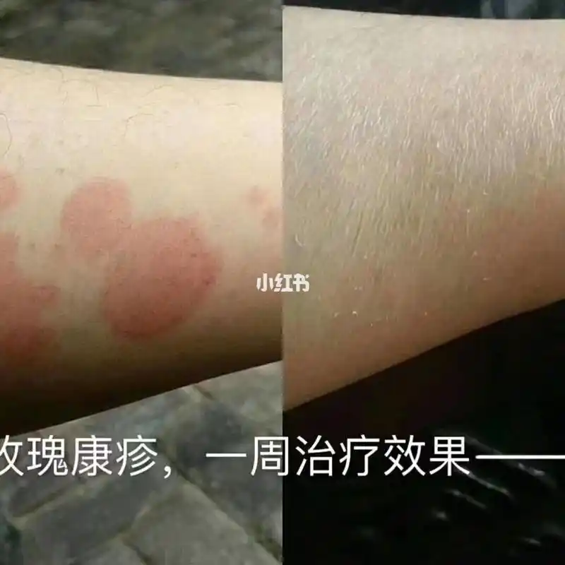 玫瑰糠疹～ 使用蟾酥膏效果