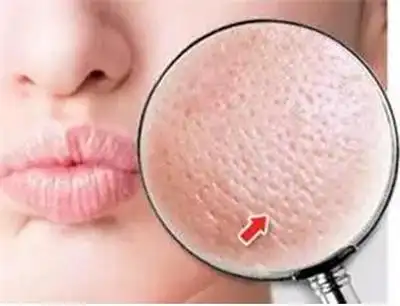 脸上出油毛孔粗大怎么办毛孔粗大的时候用一些收敛水有作用吗