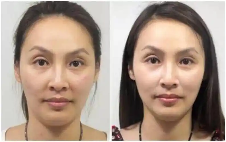 埋线提升与抗衰前后对比图 (1)-吾妮皮肤管理咨询管理机构